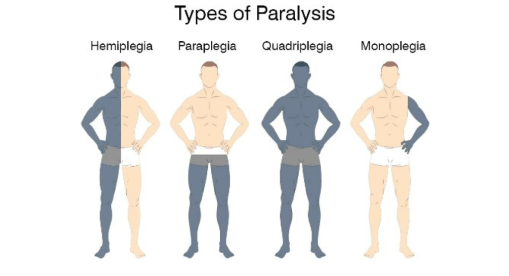 Types of Paralysis