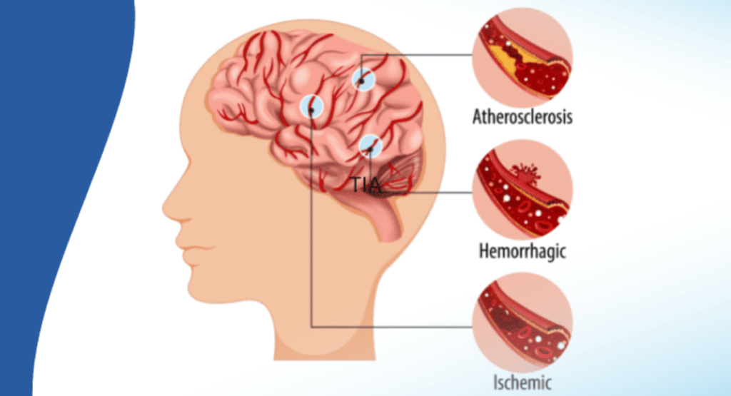 what are the symptoms of brain stroke