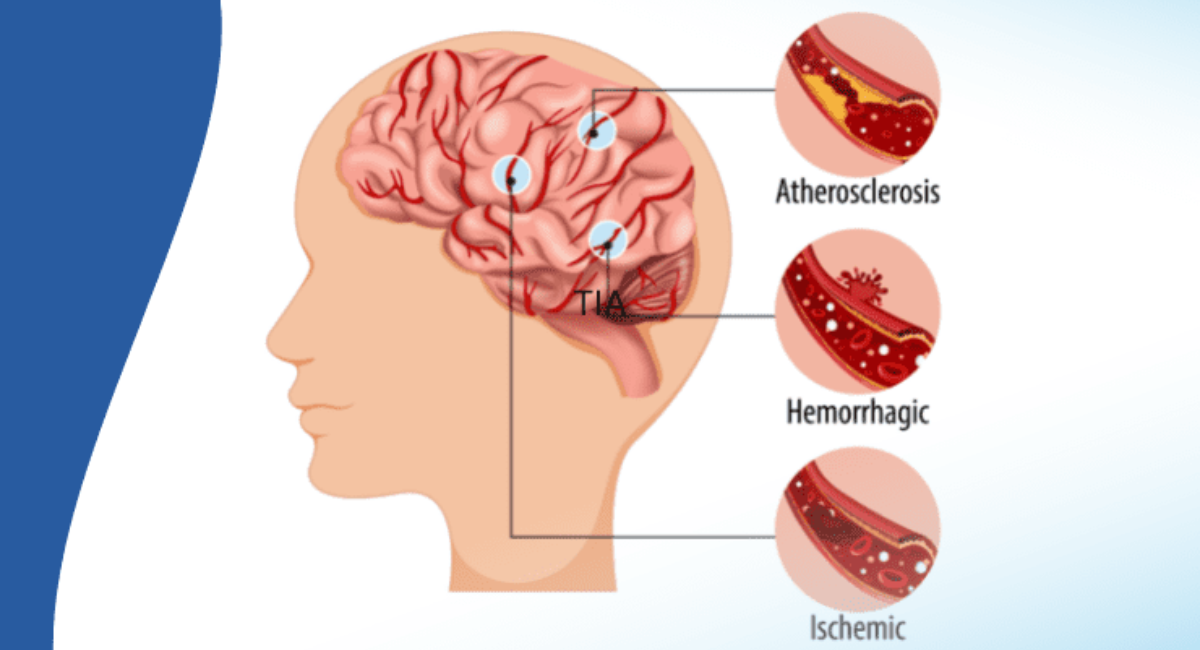 What Are the Symptoms of Brain Stroke